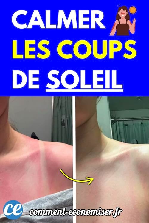 Une peau rouge et irritée par un coup de soleil, apaisée après application d’un remède.