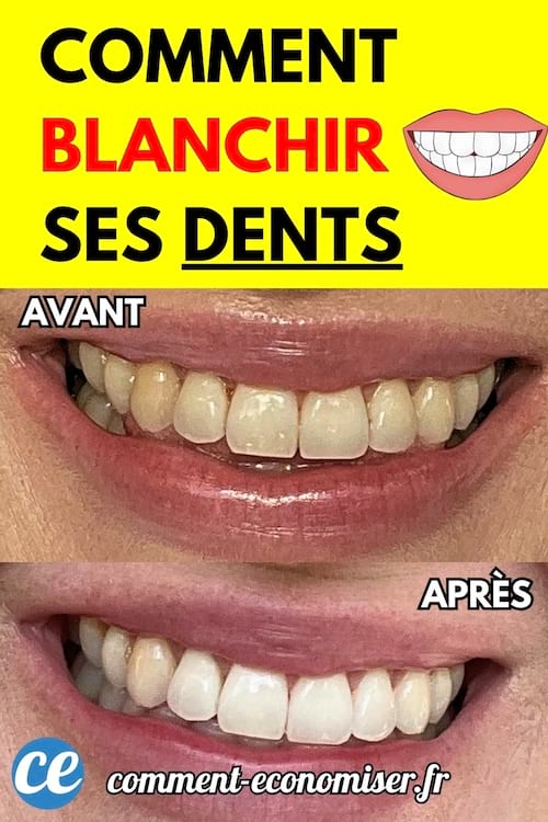 Gros plan sur un sourire montrant des dents avant et après un blanchiment.