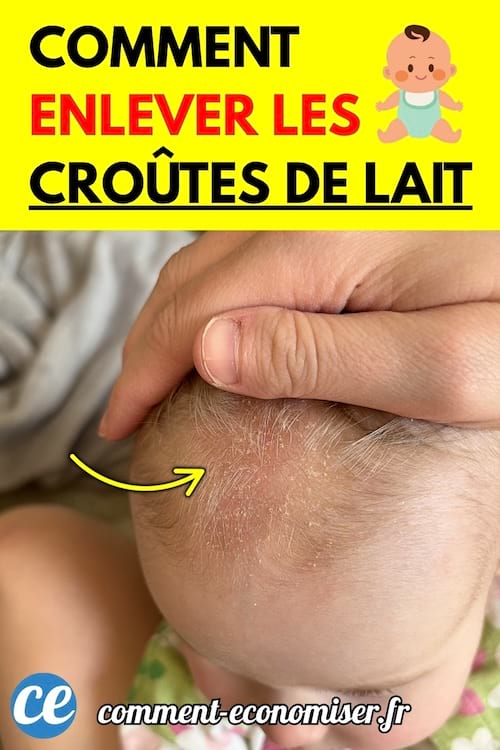 Une main d’adulte inspecte le cuir chevelu d’un bébé avec des croûtes de lait visibles.