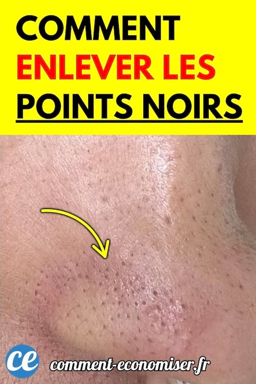 Peau du nez et des joues avec des points noirs visibles.