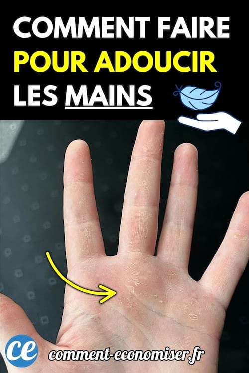 Main ouverte montrant une peau sèche avec des traces de desquamation.