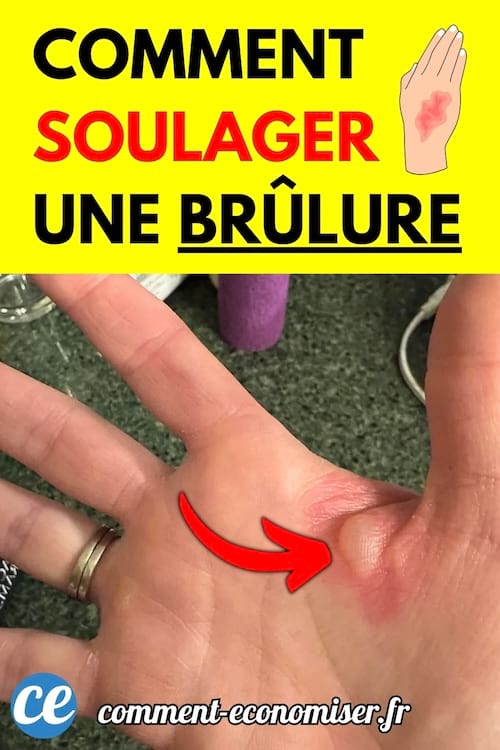 Une paume de main avec une brûlure rouge marquée en son centre.