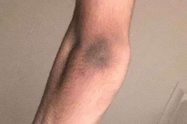 Tache sombre et violacée sur le coude.