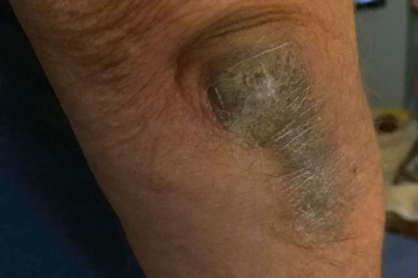 Coude foncé, très sec avec plaque rugueuse visible.