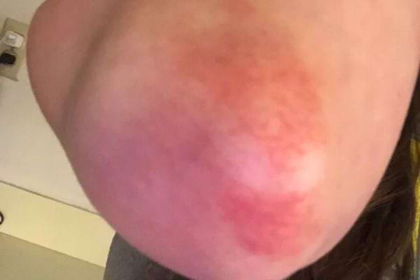 Inflammation rouge au centre du coude.