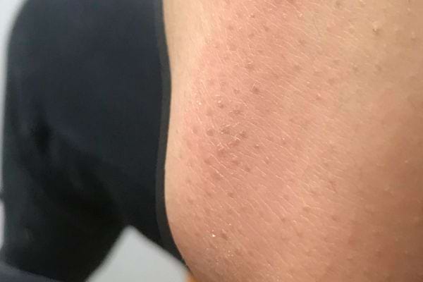 Coude clair avec peau sèche et granuleuse.