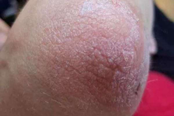 Peau rosée, sèche, légèrement irritée sur le coude.