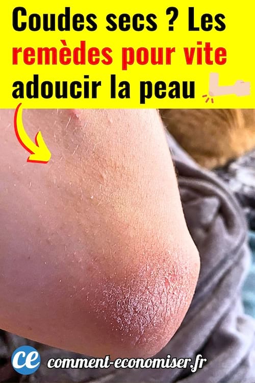 Un coude rugueux avec la peau sèche à soigner