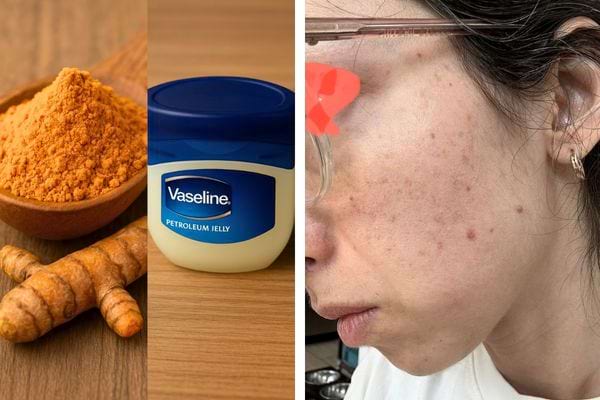 Curcuma, vaseline et visage avec acné.