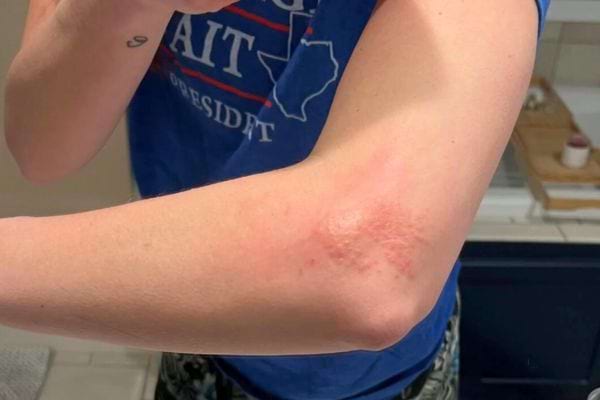 Éruption rouge sur le creux du coude.