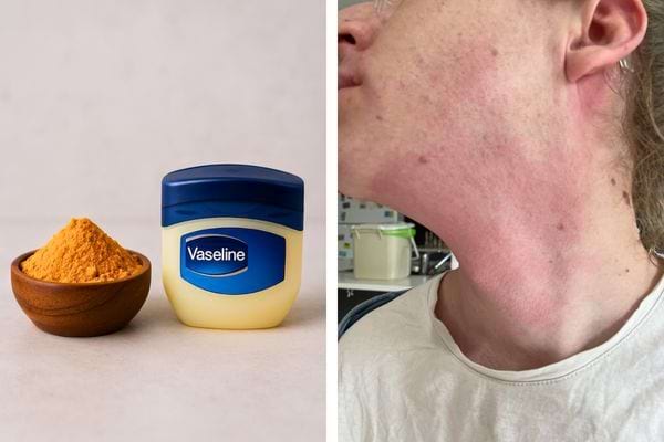 Curcuma, vaseline et irritation sur le cou.