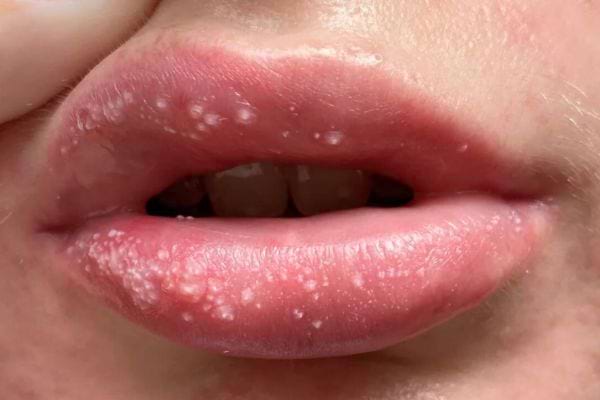 Boutons blancs nombreux visibles sur les deux lèvres.