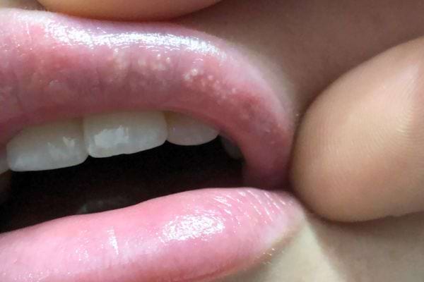 Petits points blancs discrets sur la lèvre supérieure.