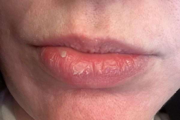 Lèvres gercées et abîmées.