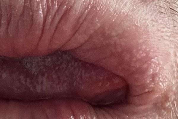 Lèvres sèches avec taches blanches marquées au centre.