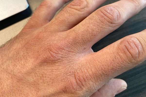 Main sèche avec peau qui pèle.