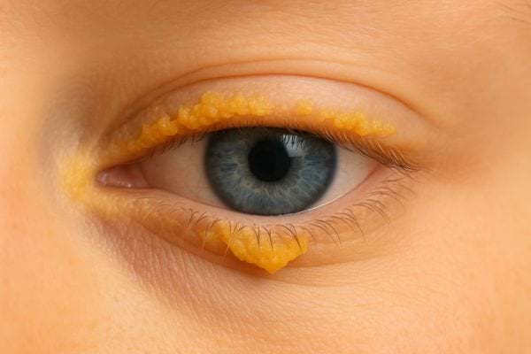 Œil bleu entouré de croûtes jaunes bien visibles.