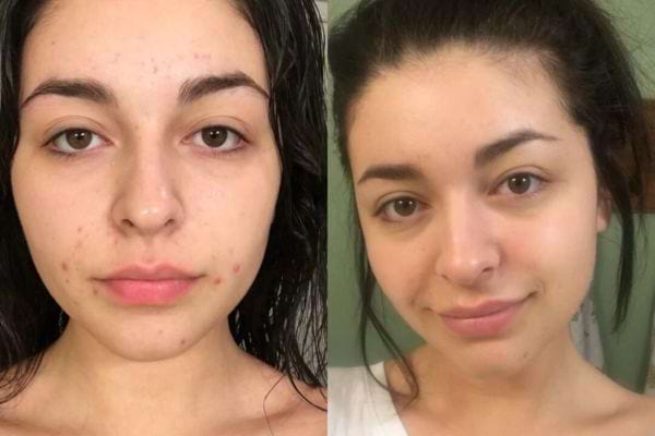 Avant/après d’un visage avec boutons puis peau nette.
