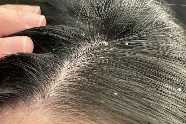 Pellicules visibles sur cuir chevelu irrité.