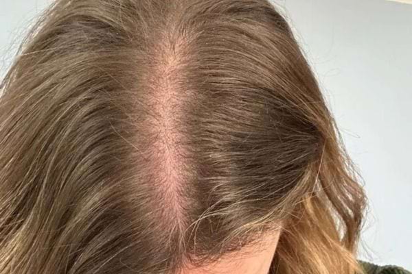 Cheveux clairsemés au sommet du crâne.