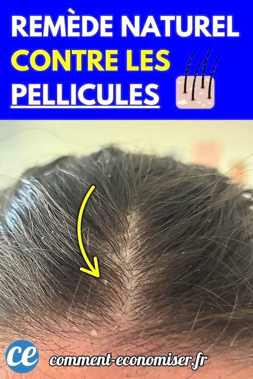 Un cuir chevelu vu de près avec des pellicules visibles au niveau de la raie.