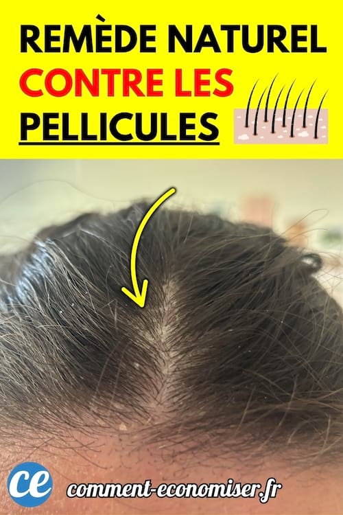 Des pellicules visibles sur un cuir chevelu brun avec une raie bien marquée au centre de la tête.