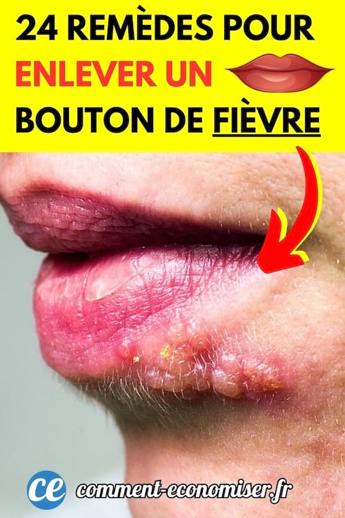 Un herpès labial a soigné sur la lèvre au naturel