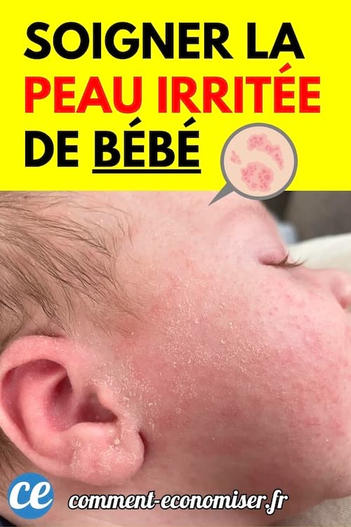 Bébé allongé de profil avec la peau du visage sèche et irritée.