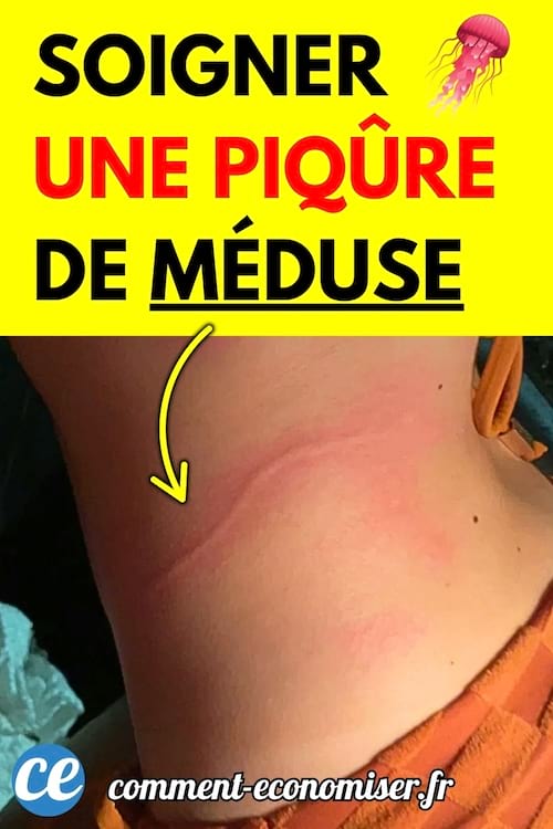 Marque rouge visible sur le ventre d’une personne après une piqûre de méduse.