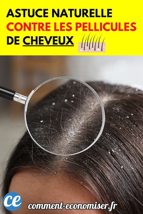 Cuir chevelu vu de près avec pellicules visibles, observé à la loupe.
