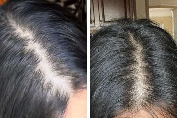 Avant-après montrant une repousse capillaire nette au centre.