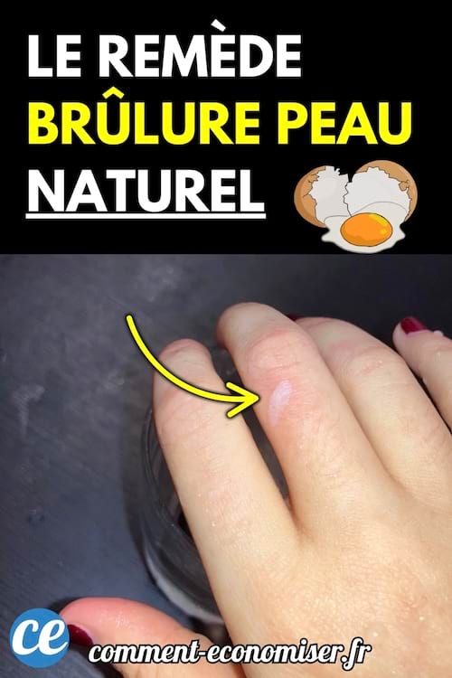 Une main avec une petite brûlure visible sur un doigt, sur fond sombre.