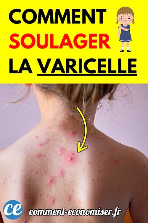 Un enfant vu de dos présentant des boutons rouges caractéristiques de la varicelle sur le haut du dos et la nuque.