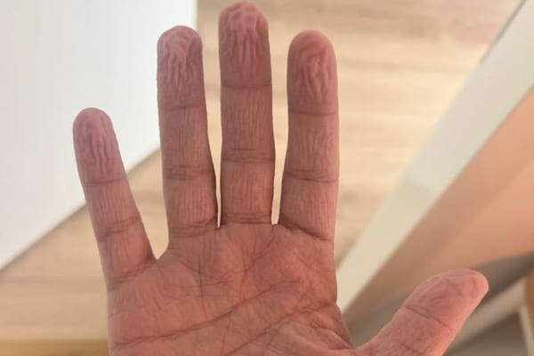 Une main fripée montre des rides dues à l’immersion prolongée dans l’eau.