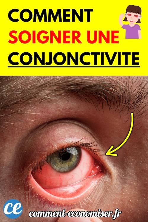 Œil rouge et irrité en gros plan, signe d’une conjonctivite.