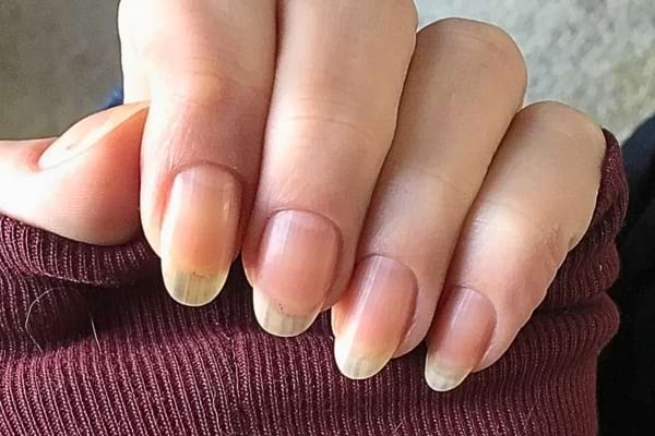 Ongles légèrement jaunes, signe possible de carence ou de déshydratation.