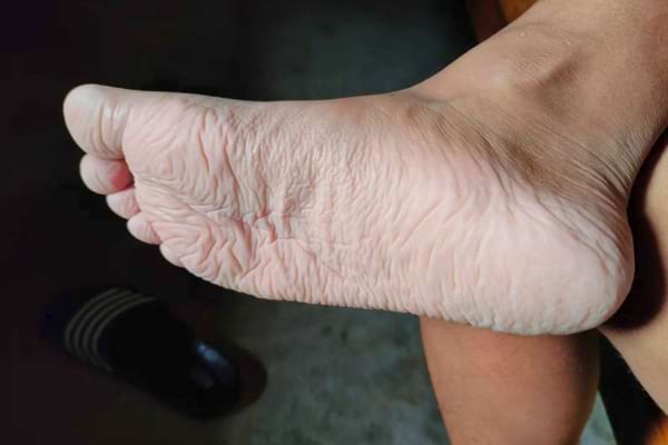 Un pied très fripé, probablement après un long bain ou une baignade.