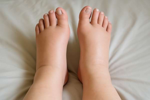 Pieds gonflés, posés sur un lit, signes de rétention.