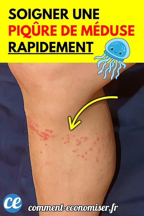 Jambe avec des piqûres rouges provoquées par une méduse, indiquées par une flèche.