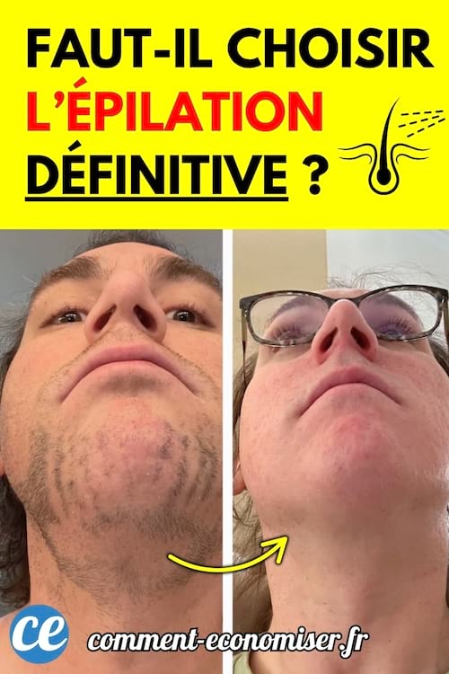 Comparaison de deux mentons : l&rsquo;un avec une pilosit&eacute; marqu&eacute;e, l&rsquo;autre parfaitement lisse apr&egrave;s &eacute;pilation d&eacute;finitive.