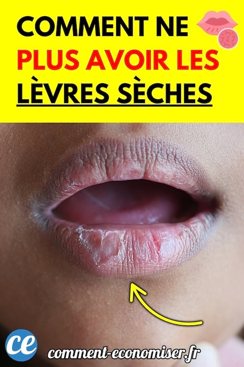 Lèvres très sèches et gercées en gros plan.