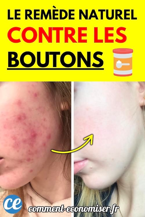 Le visage d’une jeune femme montré avant et après disparition des boutons, avec une peau nette.