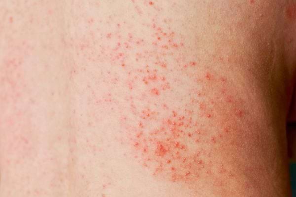 La peau du bras est couverte de petits boutons rouges serrés.