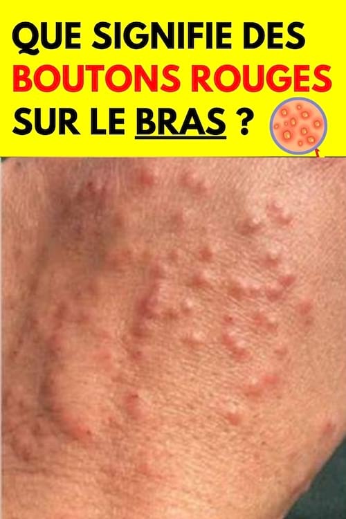 Des petits boutons rouges sur la main