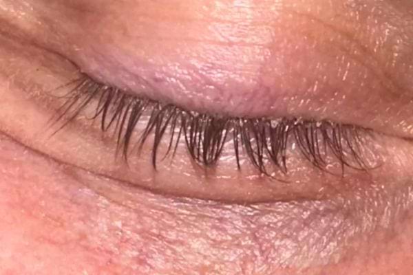 Un gros plan de cils infestés d’acariens invisibles à l’œil nu.