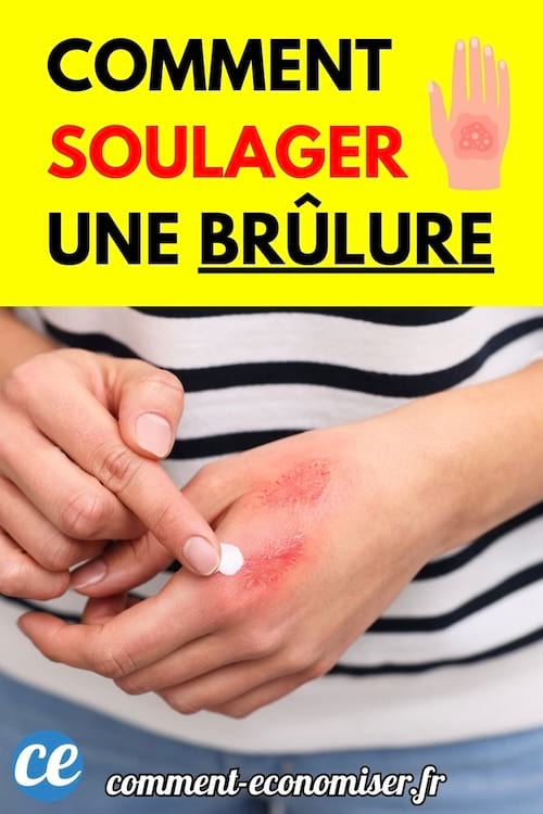 Une personne applique une crème blanche sur une brûlure rouge au dos de sa main.