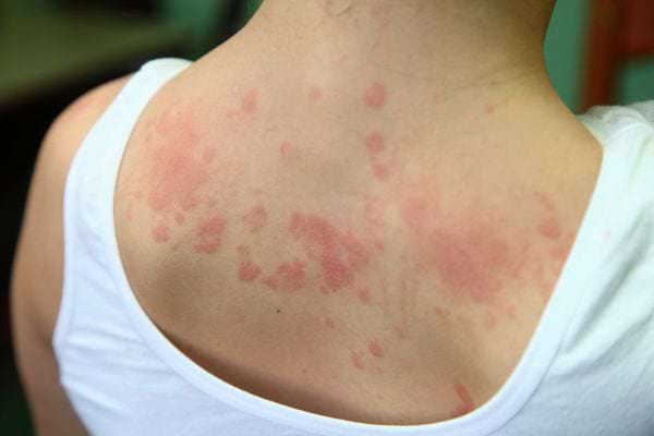 Le haut du dos présente plusieurs plaques rouges étendues.