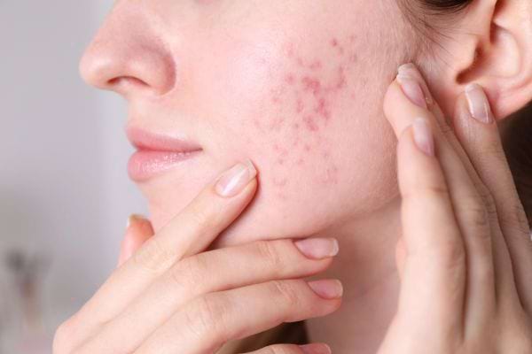 Une femme touche sa joue marquée par de l’acné rouge et inflammatoire.