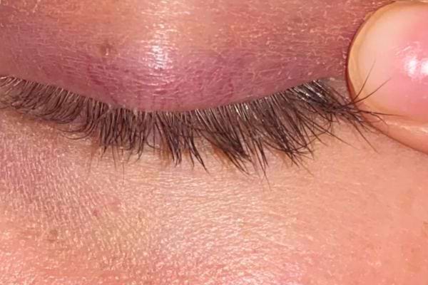 Un autre gros plan montre des cils touchés par des parasites cutanés.