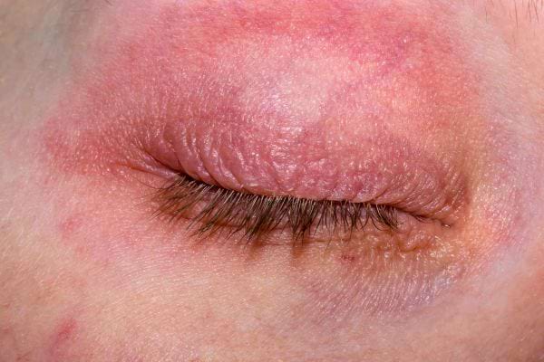 Une paupière fermée montre une forte irritation rouge et des démangeaisons.